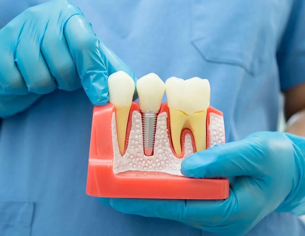 Dental Implants Tailored to You