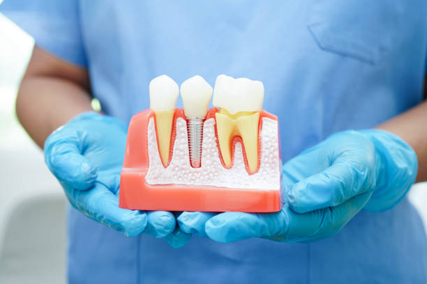 Lumiere Cosmetic and Implant Dentistry | How to Care for Your New Smile: Aftercare Tips for Implants & Veneers Aftercare for Implants and Veneers