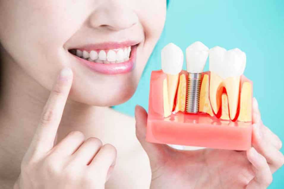 Lumiere Cosmetic and Implant Dentistry | How Long Do Dental Implants Last and How Do You Care for Them? Lumiere Cosmetic and Implant Dentistry | How Long Do Dental Implants Last and How Do You Care for Them?