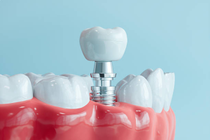 Lumiere Cosmetic and Implant Dentistry | How Long Do Dental Implants Last and How Do You Care for Them? Lumiere Cosmetic and Implant Dentistry | How Long Do Dental Implants Last and How Do You Care for Them?
