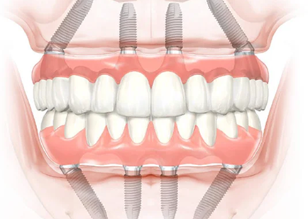 Lumiere Cosmetic and Implant Dentistry|Dental Implants