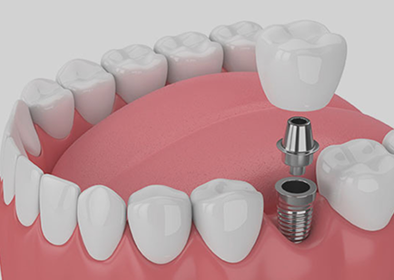 Lumiere Cosmetic and Implant Dentistry|Dental Implants