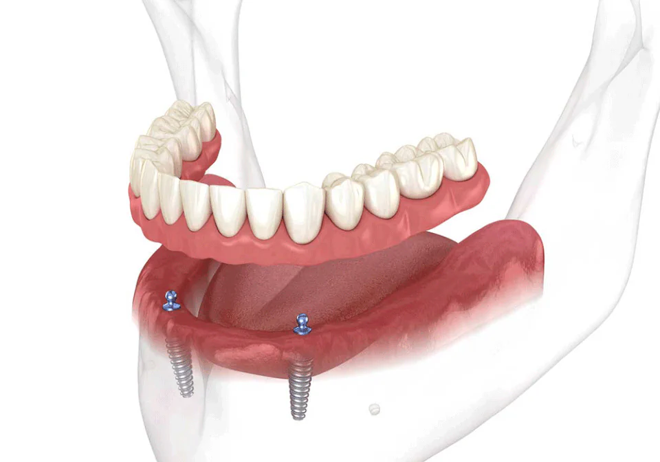Lumiere Cosmetic and Implant Dentistry|Dental Implants