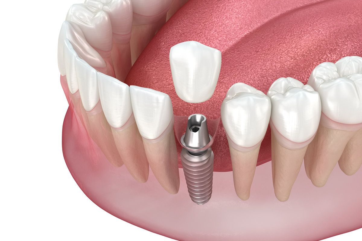 Single tooth dental implant