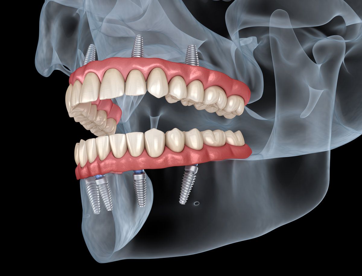 All-on-X Dental Implants